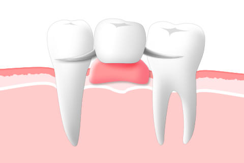 可撤性義歯
