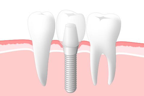 インプラント