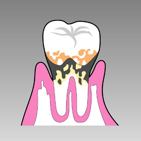 歯周病とは